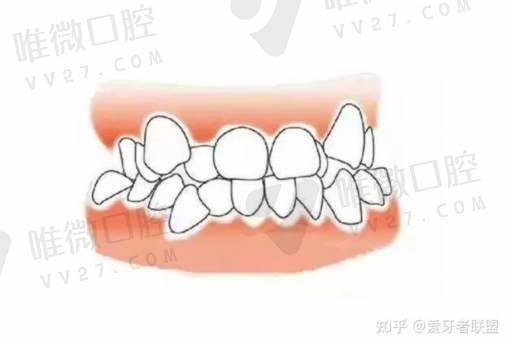 氟*牙能不能做窝沟封闭,窝沟封闭磷酸冲洗时间(图1)
